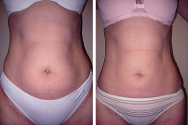 Smart Lipo Before and After Pictures Case 269, Naples and Ft. Myers, FL