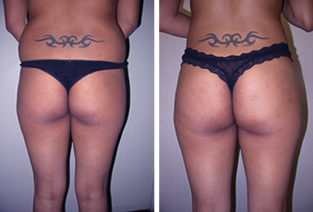 Smart Lipo Before and After Pictures