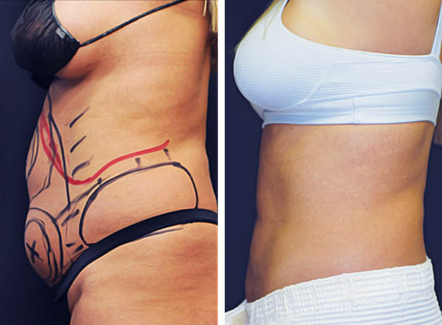Smart Lipo Abs and Flanks - Tri-Cities - Kennewick, Pasco, and Richland