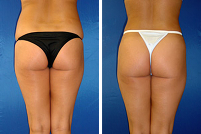 Smart Lipo Before and After Pictures